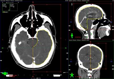 Half-Brain Delineation for Prediction of Radiation-Induced Temporal Lobe Injury in Nasopharyngeal Carcinoma Receiving Intensity-Modulated Radiotherapy